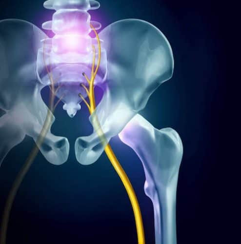 Illustration of sciatic pain