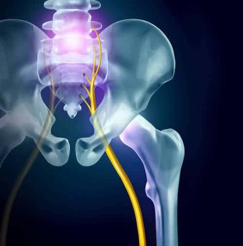 Illustration of sciatic pain